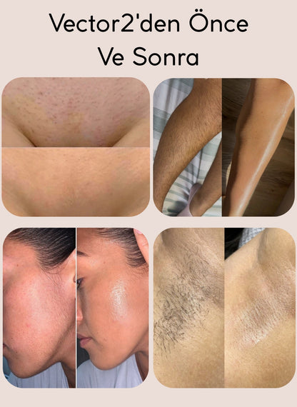 'Vector2' Hassas Bölgeler İçin Çift Başlıklı Tıraş Makinesi